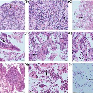 Pathology of bronchoscopic biopsy and pulmonary biopsy of chronic ...