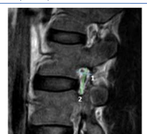 Figure From Morphometric Study Of Lumbar Spine In Nepalese Adult