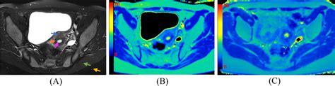 Pelvis Axial T2 Weighted Image A And T2 Maps Under 1 5 T B And 3 0 T Download Scientific