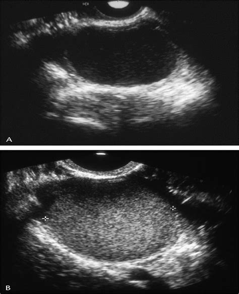 Endometriosis: Sonographic Spectrum : Ultrasound Quarterly