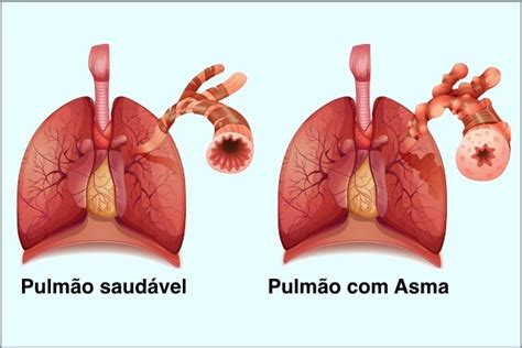 Os 35 Remédios Caseiros Para Aliviar a Asma de Forma Natural Dicas de