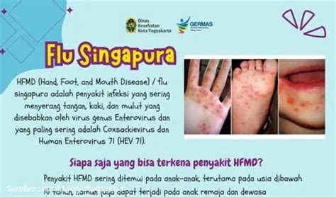 Simak 5 Cara Mengobati Flu Singapura Pada Anak Secara Alami Pigiblog