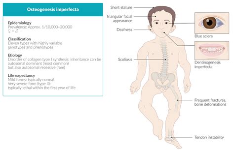 osteogenesis imperfecta life expectancy type 4 - Christopher Grissom