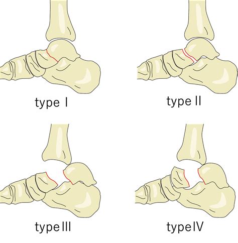 距骨骨折のレントゲン、ct画像所見のポイント、hawkins分類