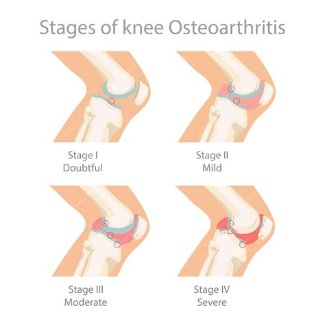 Premium Vector | Stages of knee Osteoarthritis.