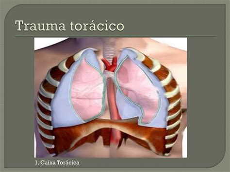 Trauma De Torax Cid BRAINCP