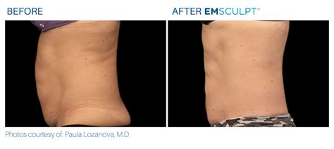 Emsculpt Body Contouring Burn Fat And Build Muscle