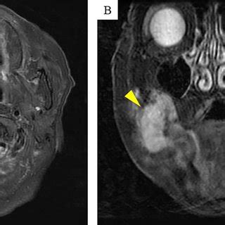 Magnetic Resonance Imaging MRI Findings Contrast Enhanced