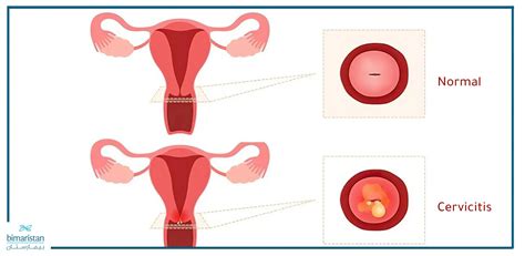 Cervicitis: Causes & Treatment in Turkey - Bimaristan