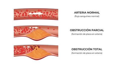 Cardiopatia Isquemica Causas Factores De Riesgo Sintomas Images