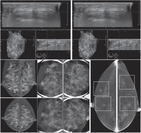 Contrast Enhanced Spectral Mammography Cesm Indications