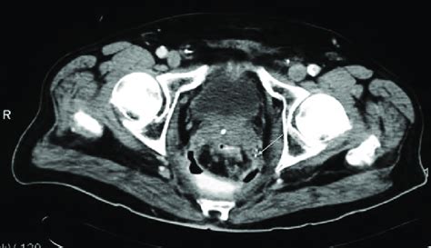 Radiographically Proven Anastomotic Leakage With Extraluminal Contrast