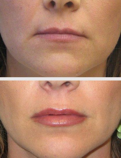 Juvederm Before And After Photos Fairfax And Washington DC