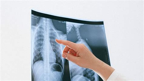 Intensity-Modulated Radiation Therapy Best for Locally Advanced NSCLC