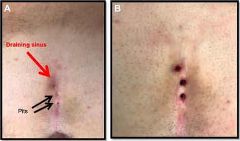 Updates On The Management Of Pilonidal Disease Advances In Pediatrics