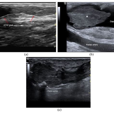 AVF thrombosis: (a) Brachio-cephalic graft. Occlusive clot (*) in the ...