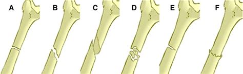 Major Fracture Types Found In Bones Mayne 2013 A Transverse B