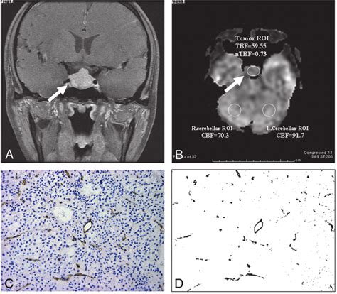 Nonfunctioning Pituitary Macroadenoma With Hypovascularity In A