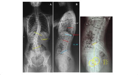 This Is A 14 Year Old Girl With Lenke Type 5 Adolescent Idiopathic Download Scientific