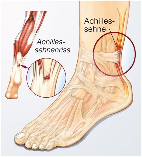 Operation An Der Achillessehne Dauer Ablauf Und Nachbehandlung