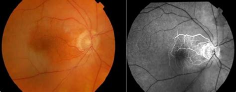 Colour Fundus Photograph And Fundus Fluorescein Angiogram Of The Right