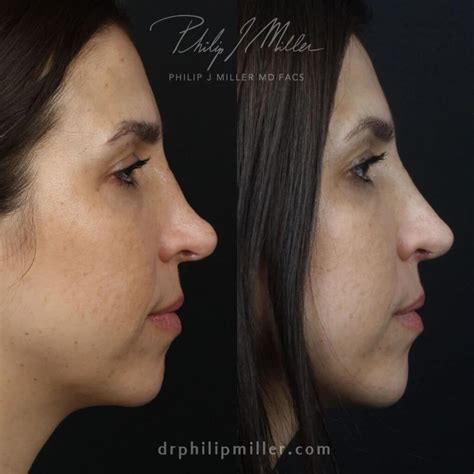 Saddle Nose Surgery In New York Philip Miller Md