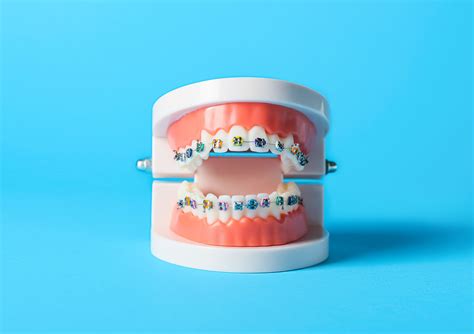 Metal Braces Braces Marietta Sandy Springs Braces