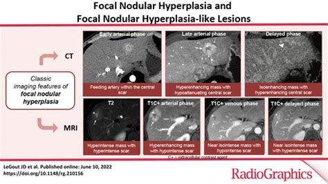 Focal Nodular Hyperplasia And Focal Nodular Hyperplasialike Lesions