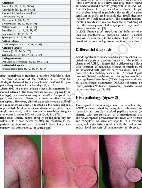 Acute Generalized Exanthematous Pustulosis