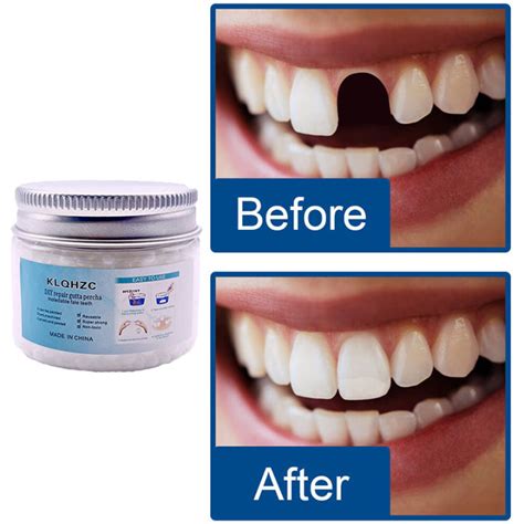 【fast Filling】diy Tooth Repair Kit Temporary Teeth Restoration 50g