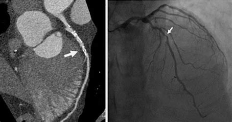 Angiogram