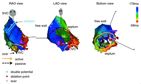 Carto Activation Map Of In The Rao View In Patient No The Solid