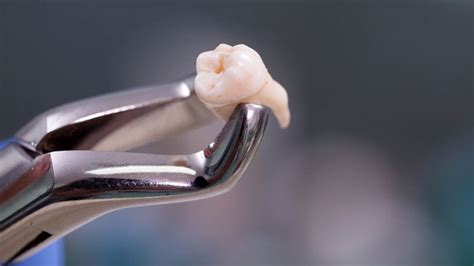 Wisdom teeth removal » Chic Dental