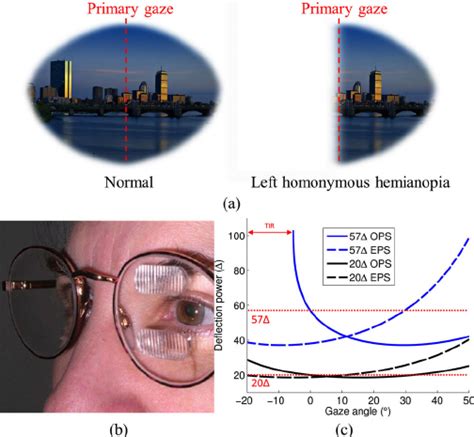 A Illustration Of Normal Binocular Visual Field Compared With That Download Scientific