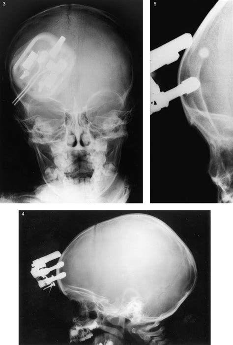 Anteroposterior Lateral And Tangential View Skull Radiographs Showing Download Scientific