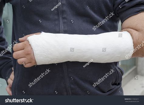16398 Cast Injury Images Stock Photos And Vectors Shutterstock