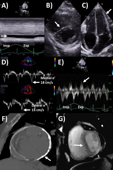 Multi Modality Imaging Evaluation Of Constrictive Pericarditis Download Scientific Diagram