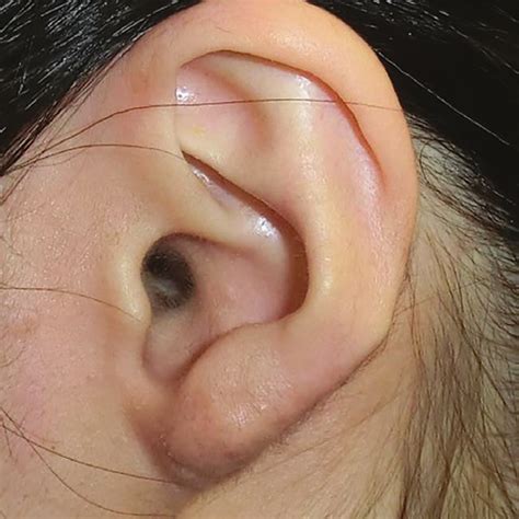 A Preoperative View Of The Anterior Ear The Keloid Involved Large Download Scientific Diagram