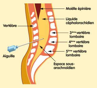 Schema ponction lombaire