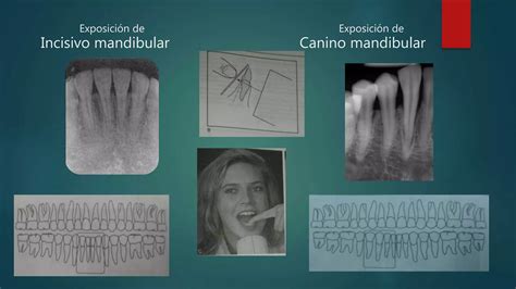 Tecnicas Radiograficas Intrabucales Ppt