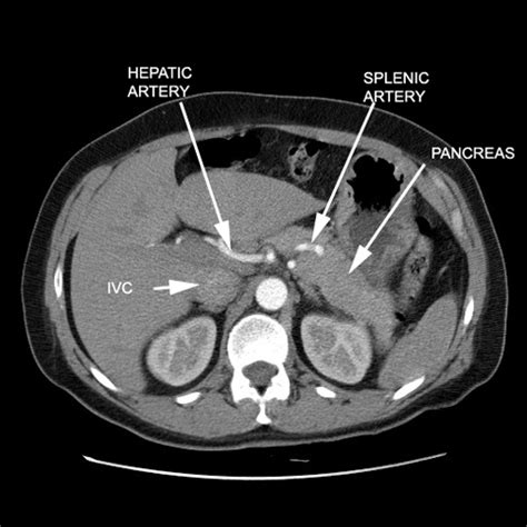 branches of celiac artery click the image for labeling