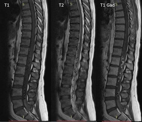 Spinal MRI: sagittal images showing a conus medullaris AVM with signs ...