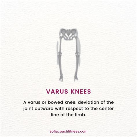 Valgus and Varus Knees
