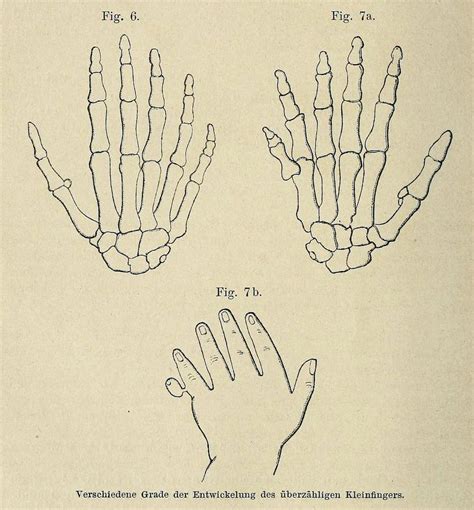 Forms Of Polydactyly Extra Digits Fig 6 Biomedical Ephemera Or