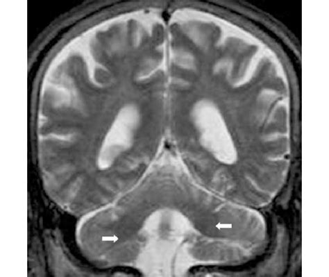 Cerebellar Peduncles Mri