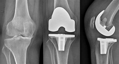 Prothèse Totale De Genou Réunion 974 Chirurgien Orthopédique