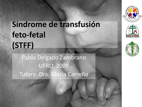 S Ndrome De Transfusi N Feto Fetal Ppt