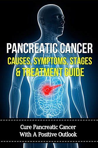 Pancreatic Cancer Causes Symptoms Stages Treatment Guide Cure