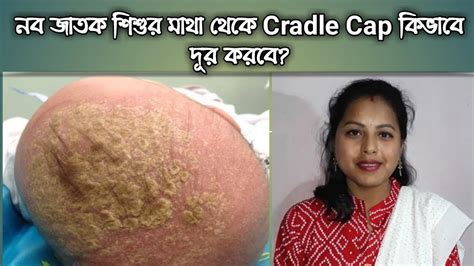 How To Remove Cradle Cap In Babies নবজাতক শিশুর মাথা থেকে Cradle Cap