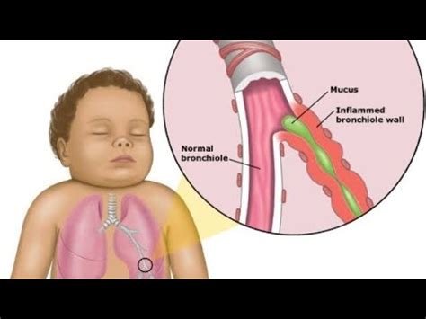 Bronkiolitis Bersama Dr Ulwan Youtube